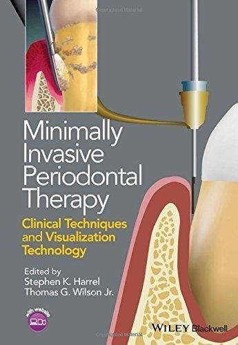 Minimally Invasive Periodontal Therapy Clinical Techniques And Visualization Technology by Stephen K. Harrel, Thomas G. Wilson Jr. - 1118607627